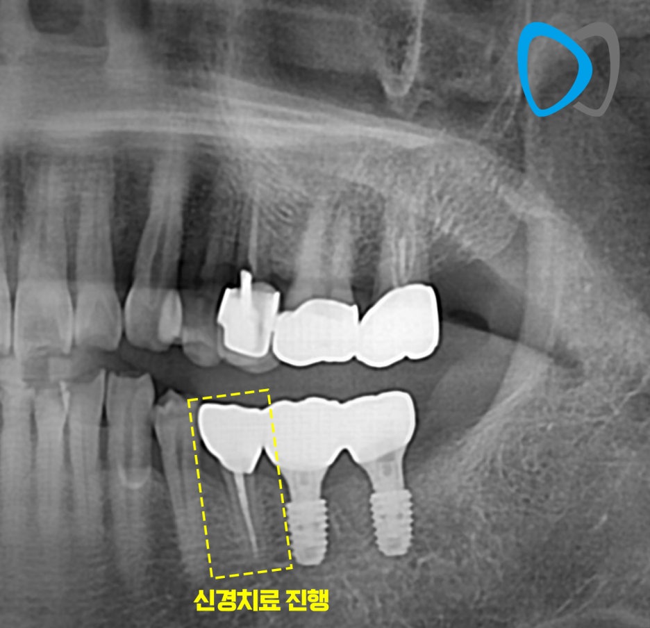 치료 후