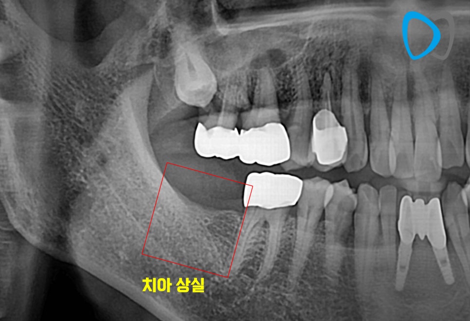 치료 전