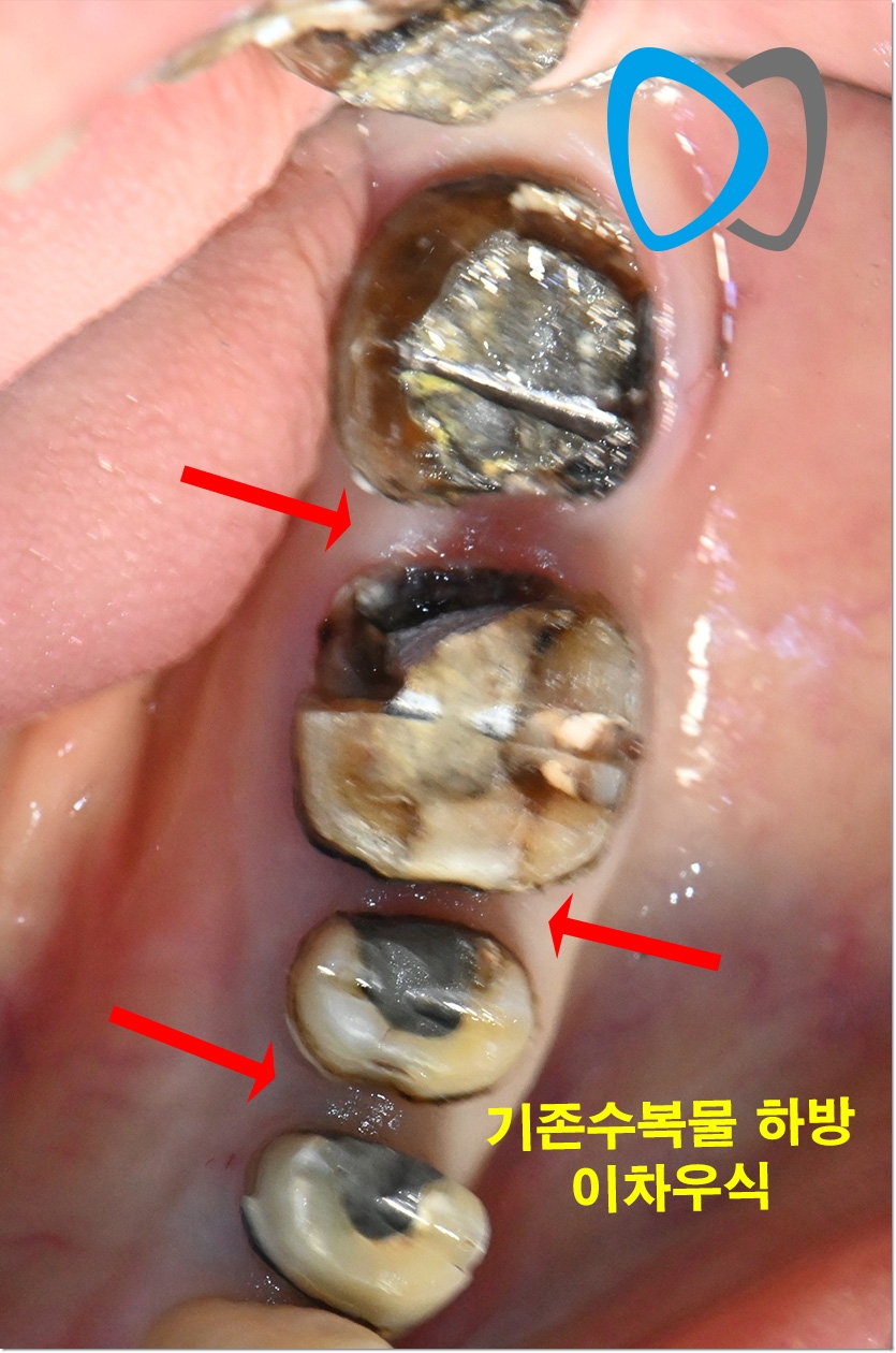 치료 전